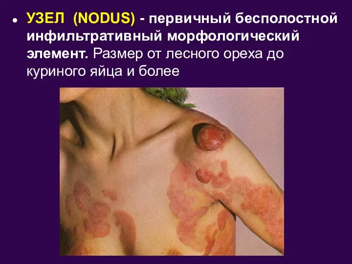 УЗЕЛ (NODUS) - первичный бесполостной инфильтративный морфологический элемент. Размер от лесного ореха