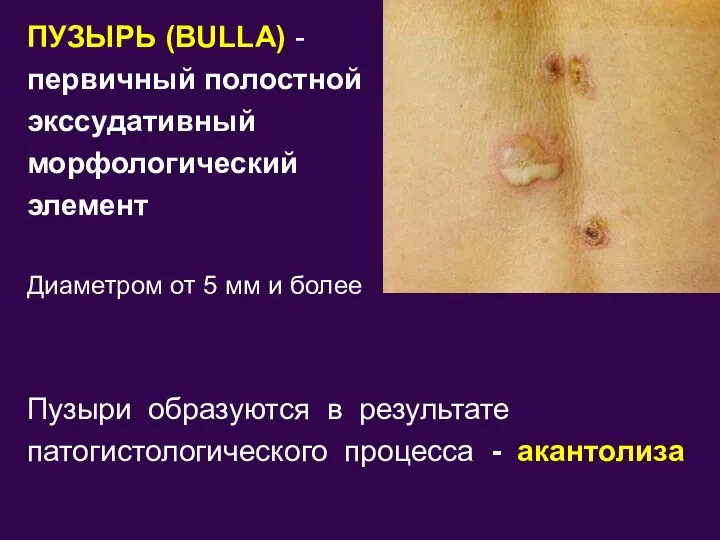 ПУЗЫРЬ (BULLA) - первичный полостной экссудативный морфологический элемент Диаметром от 5 мм