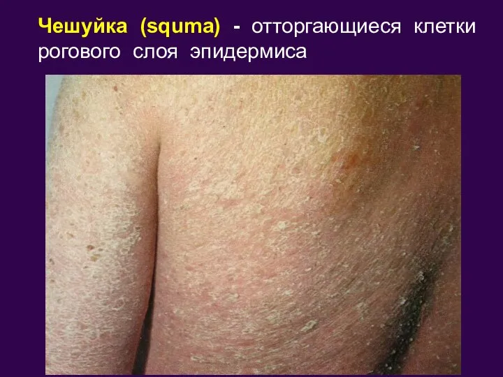 Чешуйка (squma) - отторгающиеся клетки рогового слоя эпидермиса