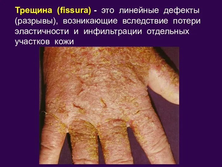Трещина (fissura) - это линейные дефекты (разрывы), возникающие вследствие потери эластичности и инфильтрации отдельных участков кожи