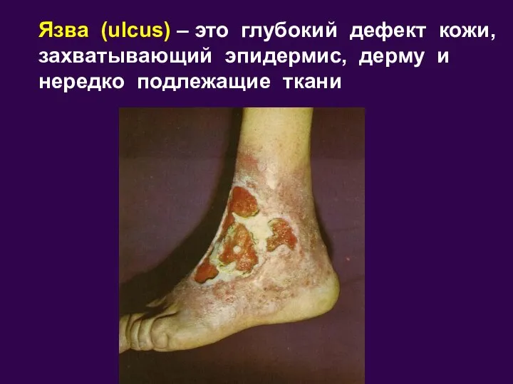 Язва (ulcus) – это глубокий дефект кожи, захватывающий эпидермис, дерму и нередко подлежащие ткани