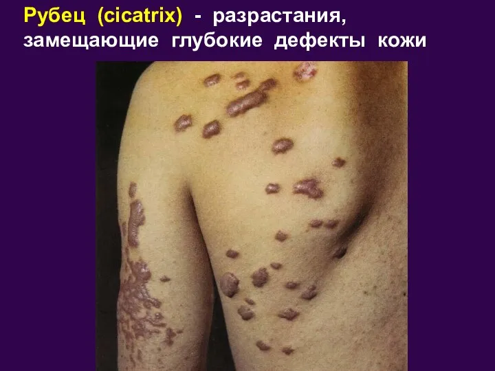 Рубец (cicatrix) - разрастания, замещающие глубокие дефекты кожи