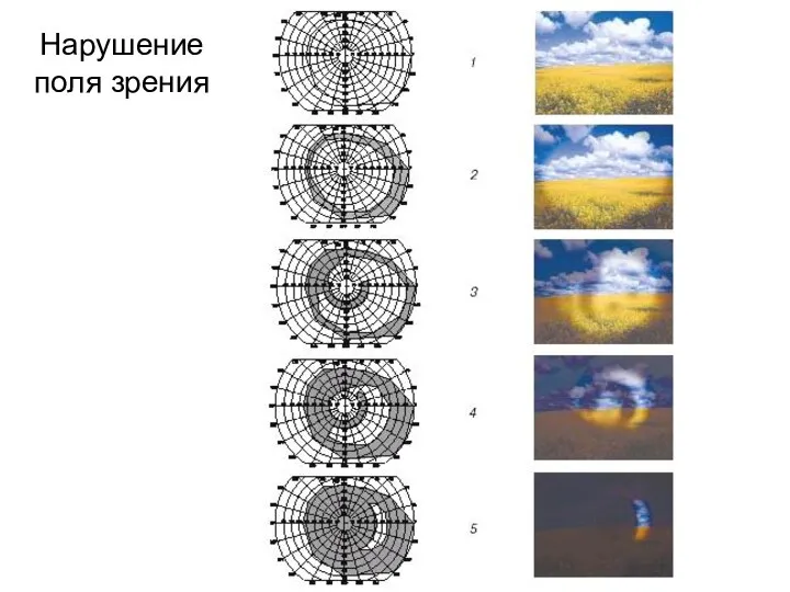 Нарушение поля зрения