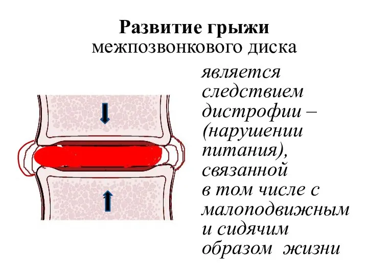 Развитие грыжи межпозвонкового диска является следствием дистрофии – (нарушении питания), связанной в