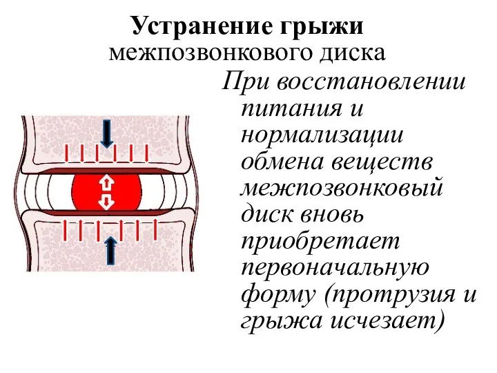 Устранение грыжи межпозвонкового диска При восстановлении питания и нормализации обмена веществ межпозвонковый