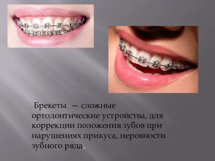 Брекеты — сложные ортодонтические устройства, для коррекции положения зубов при нарушениях прикуса, неровности зубного ряда.