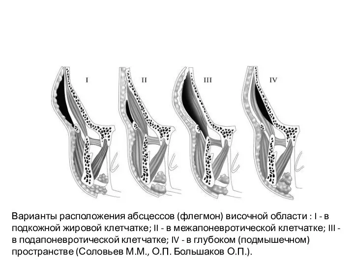 Варианты расположения абсцессов (флегмон) височной области : I - в подкожной жировой