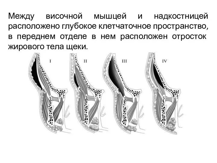 Между височной мышцей и надкостницей расположено глубокое клетчаточное пространство, в переднем отделе