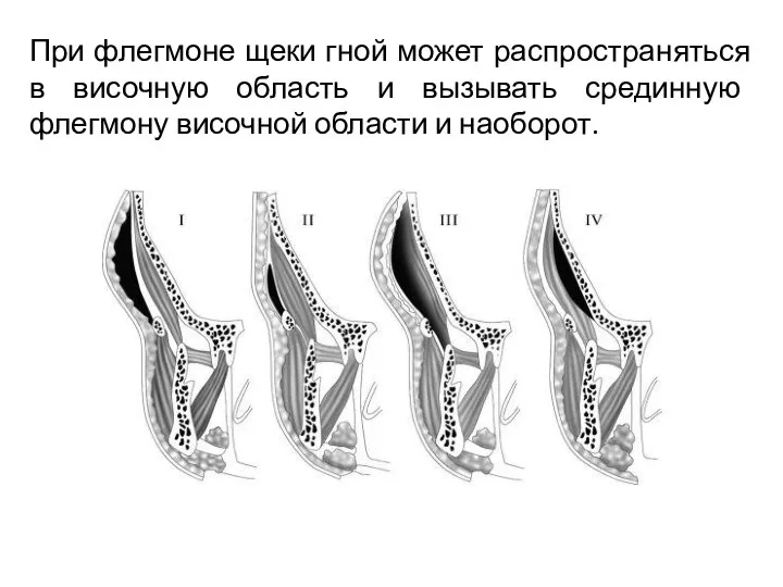 При флегмоне щеки гной может распространяться в височную область и вызывать срединную