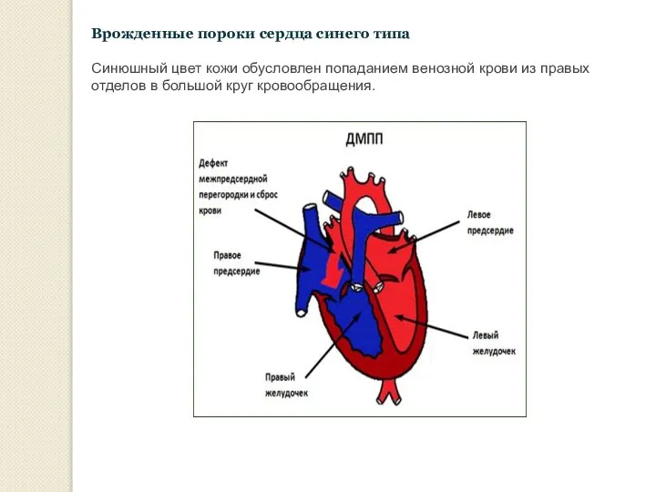 Врожденные пороки сердца синего типа Синюшный цвет кожи обусловлен попаданием венозной крови