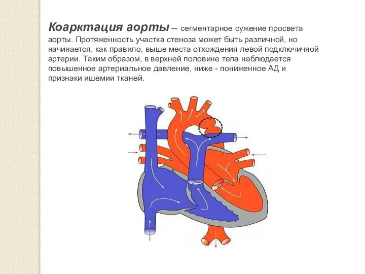 Коарктация аорты — сегментарное сужение просвета аорты. Протяженность участка стеноза может быть