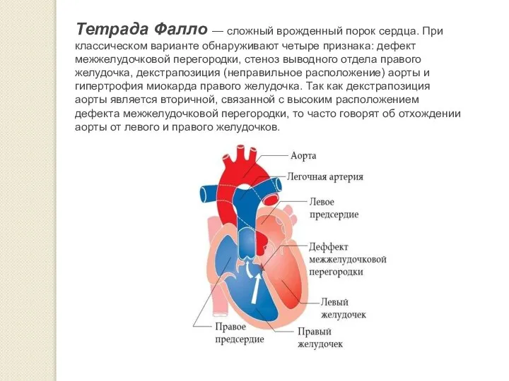 Тетрада Фалло — сложный врожденный порок сердца. При классическом варианте обнаруживают четыре
