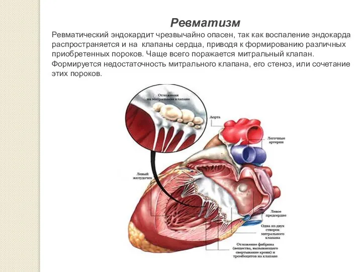 Ревматизм Ревматический эндокардит чрезвычайно опасен, так как воспаление эндокарда распространяется и на