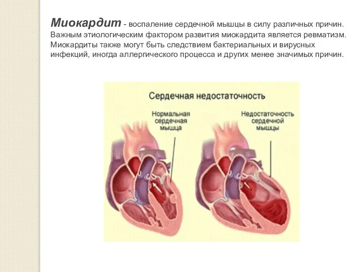 Миокардит - воспаление сердечной мышцы в силу различных причин. Важным этиологическим фактором