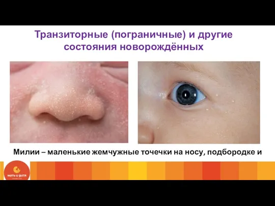 Милии – маленькие жемчужные точечки на носу, подбородке и щеках. Транзиторные (пограничные) и другие состояния новорождённых