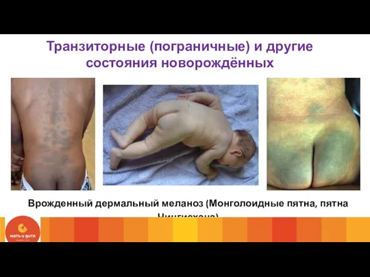 Врожденный дермальный меланоз (Монголоидные пятна, пятна Чингисхана) Транзиторные (пограничные) и другие состояния новорождённых