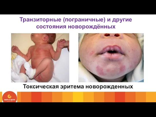 Токсическая эритема новорожденных Транзиторные (пограничные) и другие состояния новорождённых