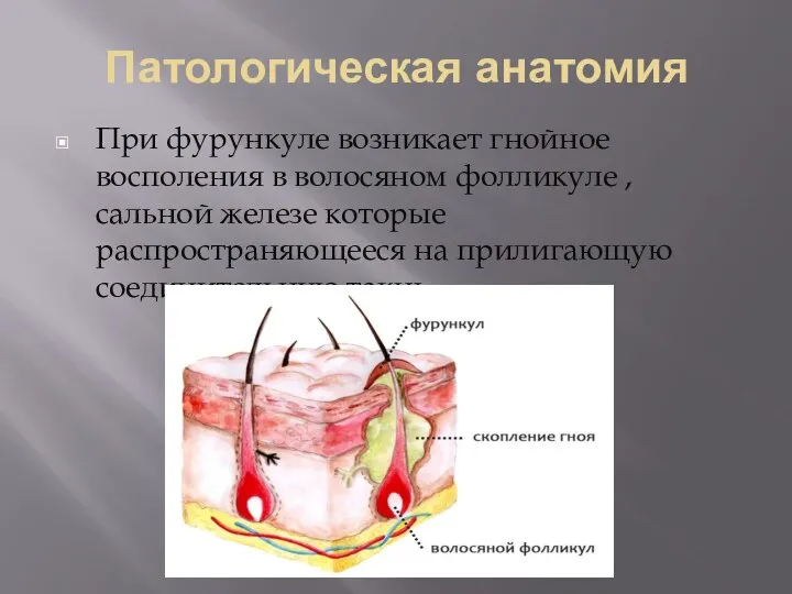 Патологическая анатомия При фурункуле возникает гнойное восполения в волосяном фолликуле , сальной