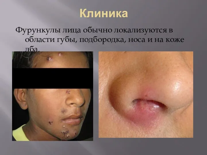 Клиника Фурункулы лица обычно локализуются в области губы, подбородка, носа и на коже лба.
