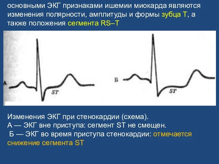 основными ЭКГ признаками ишемии миокарда являются изменения полярности, амплитуды и формы зубца