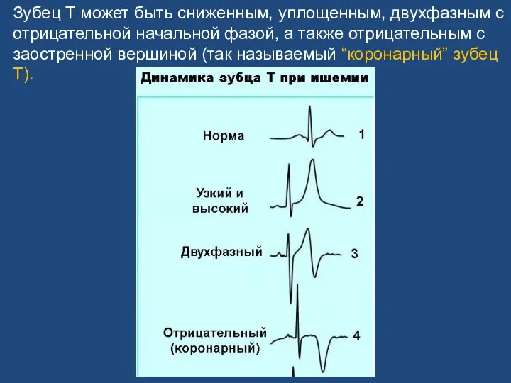 Зубец Т может быть сниженным, уплощенным, двухфазным с отрицательной начальной фазой, а