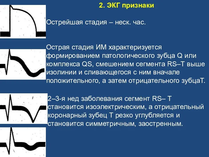 2. ЭКГ признаки Острейшая стадия – неск. час. Острая стадия ИМ характеризуется