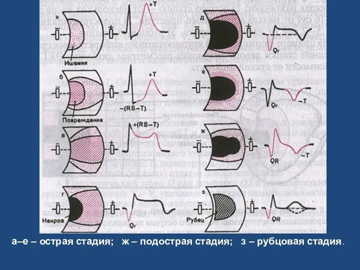 а–е – острая стадия; ж – подострая стадия; з – рубцовая стадия.