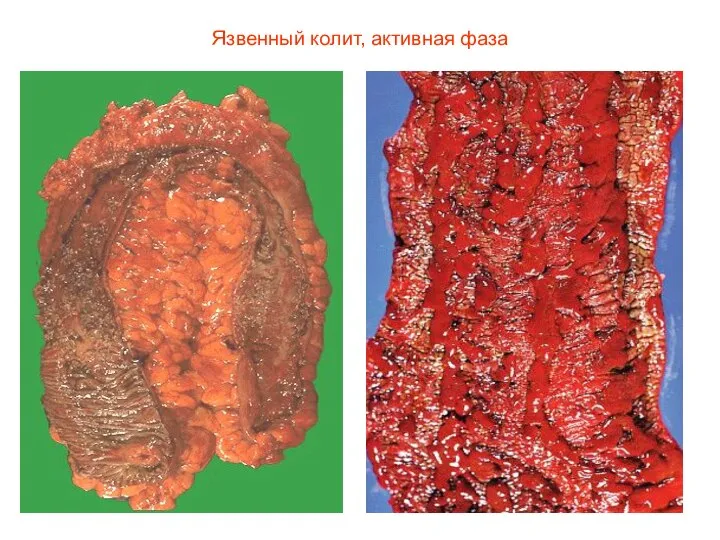 Язвенный колит, активная фаза