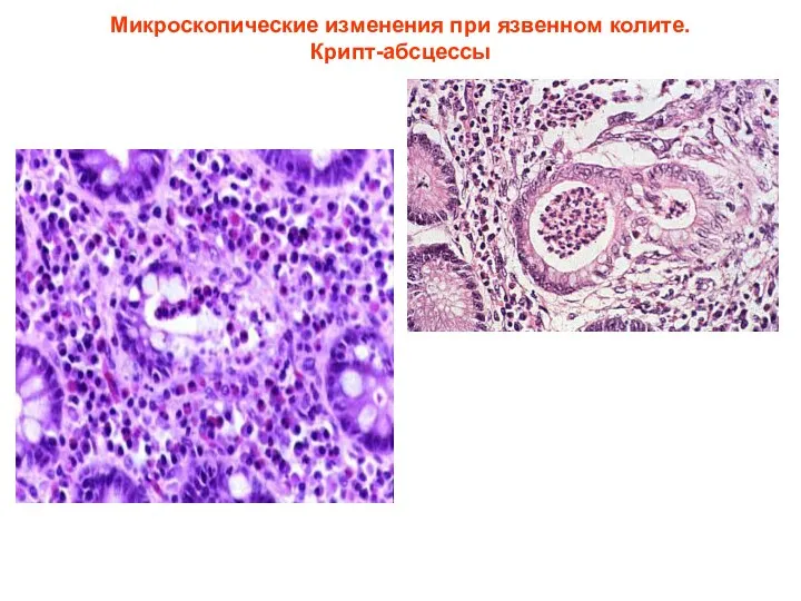 Микроскопические изменения при язвенном колите. Крипт-абсцессы