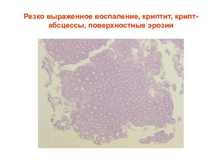 Резко выраженное воспаление, криптит, крипт-абсцессы, поверхностные эрозии