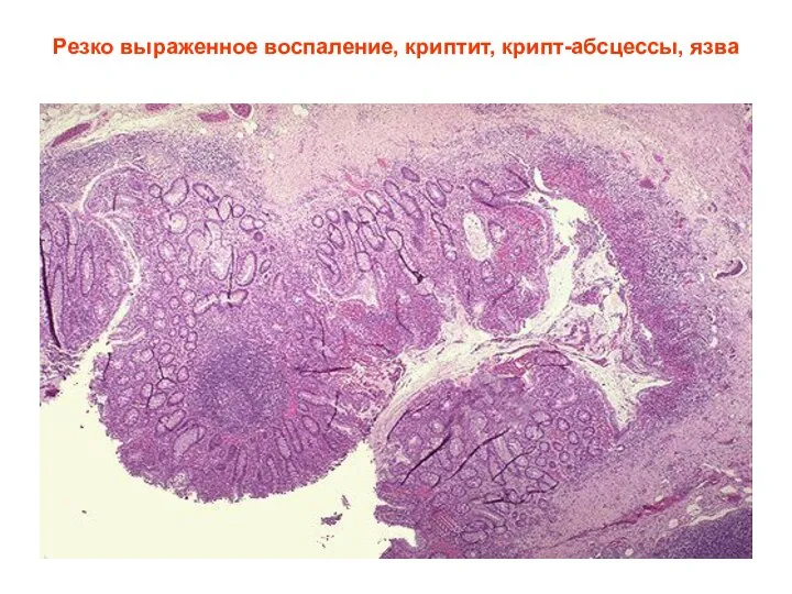 Резко выраженное воспаление, криптит, крипт-абсцессы, язва