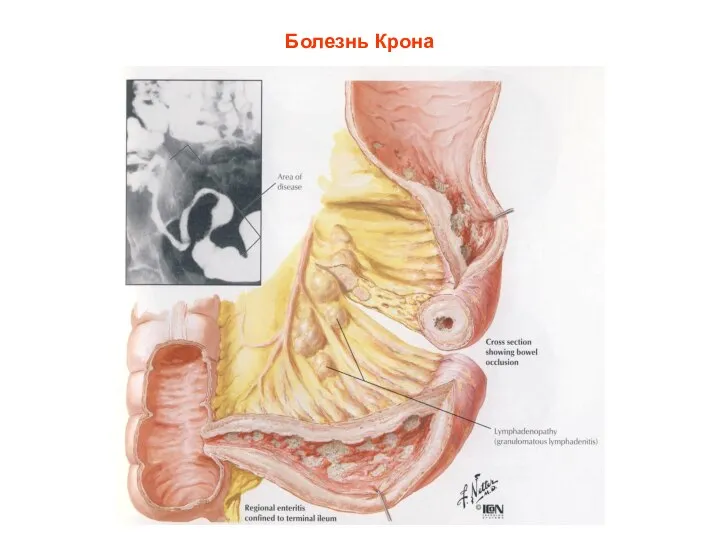 Болезнь Крона