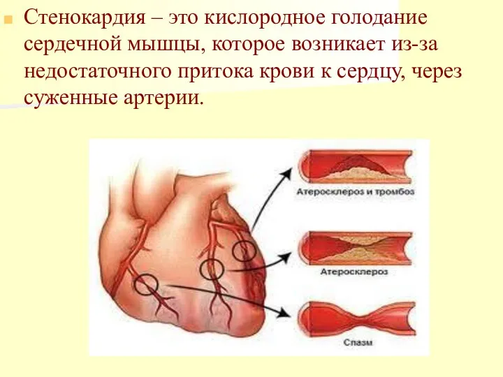 Стенокардия – это кислородное голодание сердечной мышцы, которое возникает из-за недостаточного притока