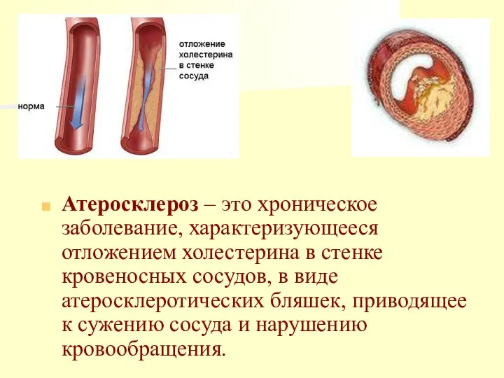 Атеросклероз – это хроническое заболевание, характеризующееся отложением холестерина в стенке кровеносных сосудов,