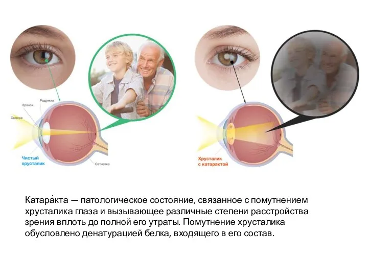 Катара́кта — патологическое состояние, связанное с помутнением хрусталика глаза и вызывающее различные