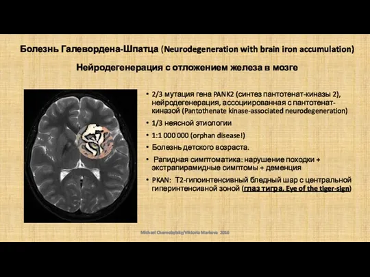 Болезнь Галевордена-Шпатца (Neurodegeneration with brain iron accumulation) Нейродегенерация с отложением железа в