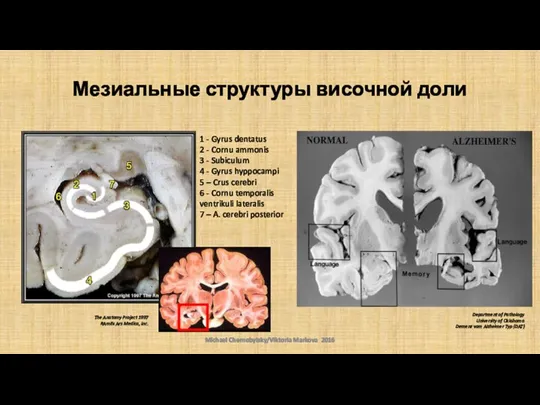 Мезиальные структуры височной доли 1 - Gyrus dentatus 2 - Cornu ammonis