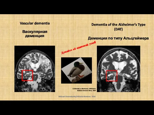 Vascular dementia Васкулярная деменция Думайте об одинокой утке! Michael Chernobylsky/Viktoria Markova 2016