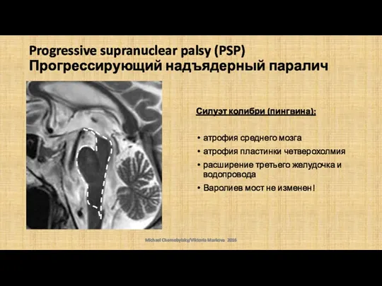 Progressive supranuclear palsy (PSP) Прогрессирующий надъядерный паралич Силуэт колибри (пингвина): атрофия среднего