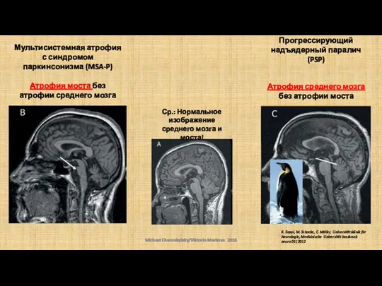 Прогрессирующий надъядерный паралич (PSP) Атрофия среднего мозга без атрофии моста Michael Chernobylsky/Viktoria