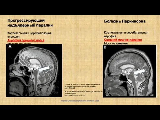 Michael Chernobylsky/Viktoria Markova 2016 Болезнь Паркинсона Кортикальная и церебеллярная атрофия Средний мозг