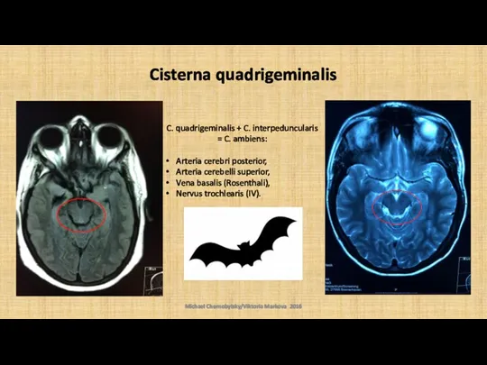 Cisterna quadrigeminalis Michael Chernobylsky/Viktoria Markova 2016 C. quadrigeminalis + C. interpeduncularis =