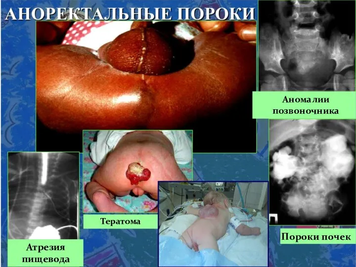 Аномалии позвоночника Пороки почек Тератома Атрезия пищевода