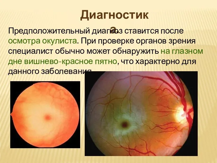 Диагностика. Предположительный диагноз ставится после осмотра окулиста. При проверке органов зрения специалист