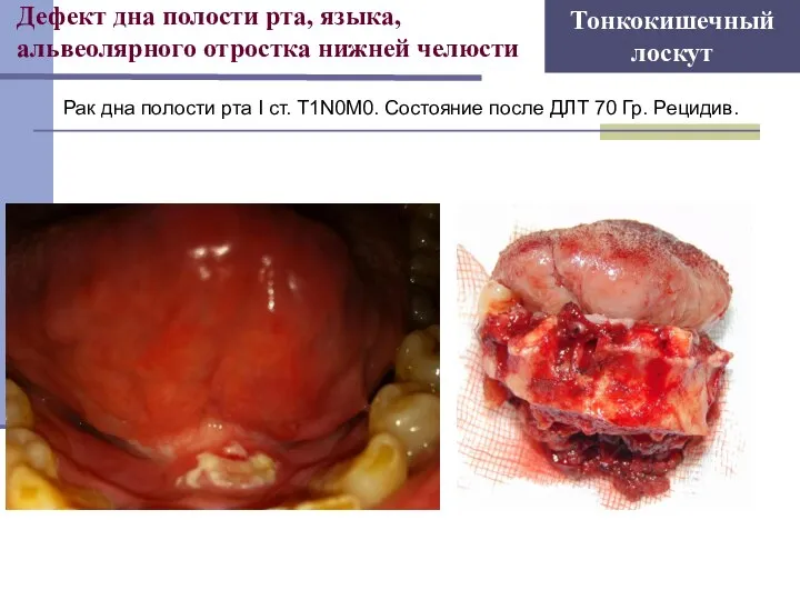 Рак дна полости рта I ст. T1N0M0. Состояние после ДЛТ 70 Гр.