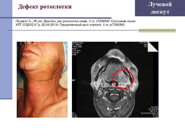 Дефект ротоглотки Лучевой лоскут Пациент С., 56 лет. Диагноз: рак ротоглотки слева