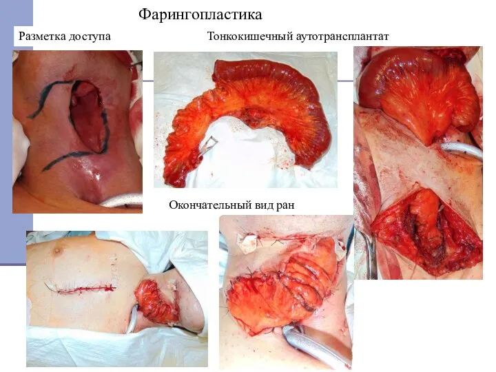 Разметка доступа Тонкокишечный аутотрансплантат Фарингопластика Окончательный вид ран