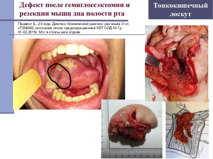 Дефект после гемиглоссэктомии и резекции мышц дна полости рта Тонкокишечный лоскут Пациент