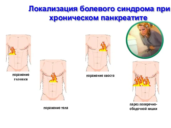 Локализация болевого синдрома при хроническом панкреатите поражение головки