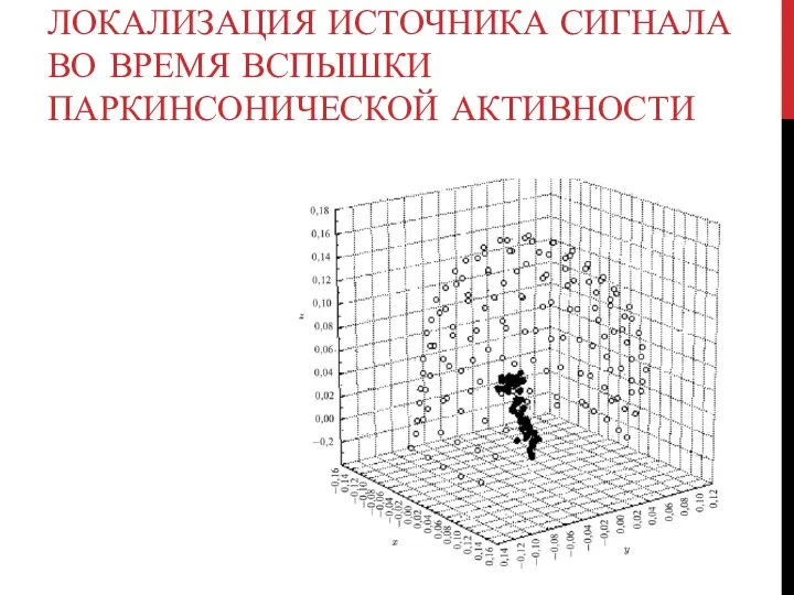 ЛОКАЛИЗАЦИЯ ИСТОЧНИКА СИГНАЛА ВО ВРЕМЯ ВСПЫШКИ ПАРКИНСОНИЧЕСКОЙ АКТИВНОСТИ